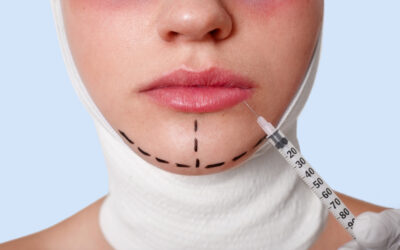 Chin Implants Popular Among Men and Women