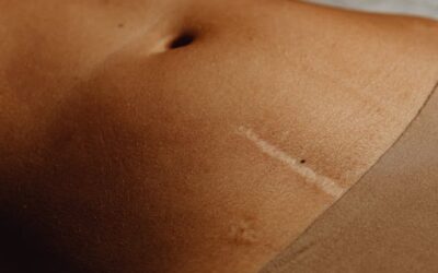 Plastic Surgeon Can Get Rid of Scars