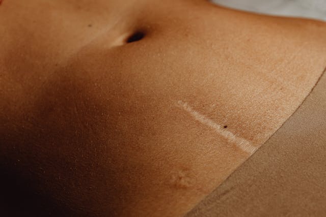 Plastic Surgeon Can Get Rid of Scars