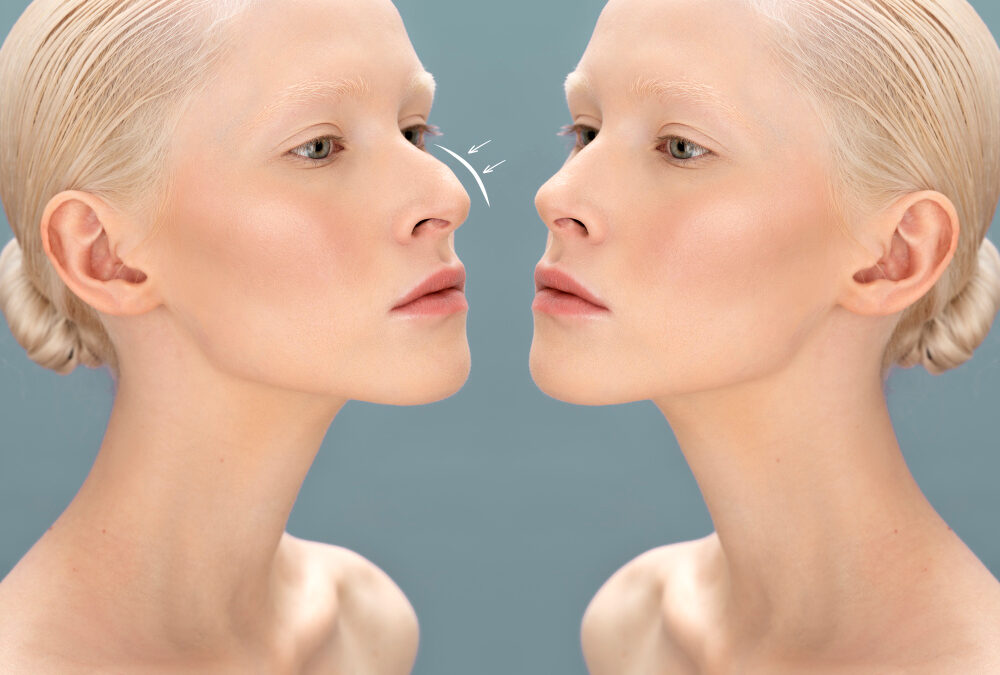 FAQs About Rhinoplasties