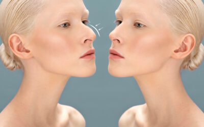 FAQs About Rhinoplasties