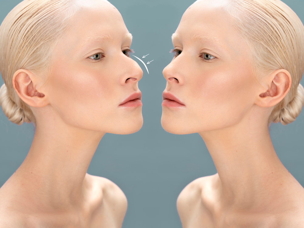 FAQs About Rhinoplasties