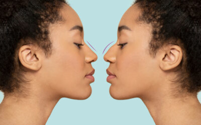 Common Reasons For Having A Rhinoplasty