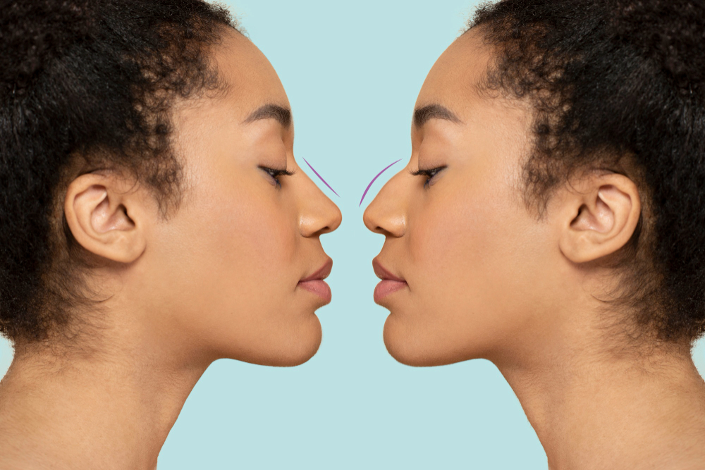 Common Reasons For Having A Rhinoplasty