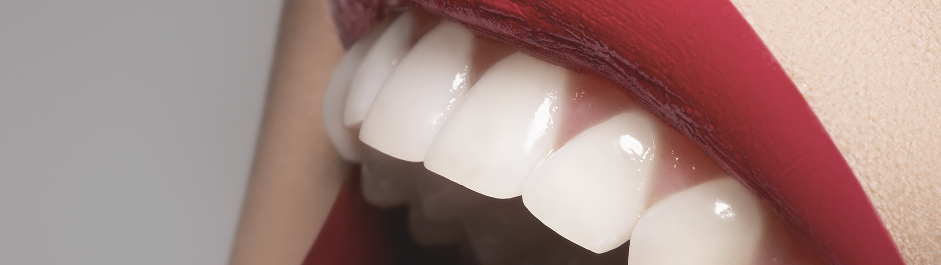 Top 5 Reasons You May Need Dental Implants