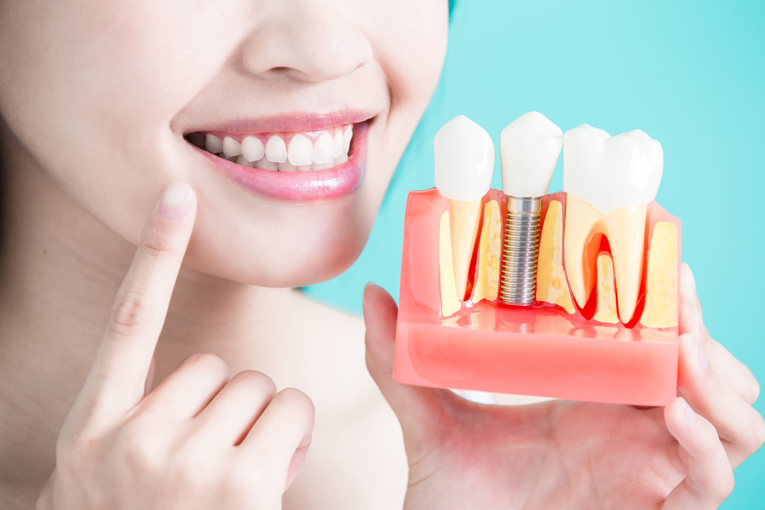 What Are the Differences Between Dental Implants?