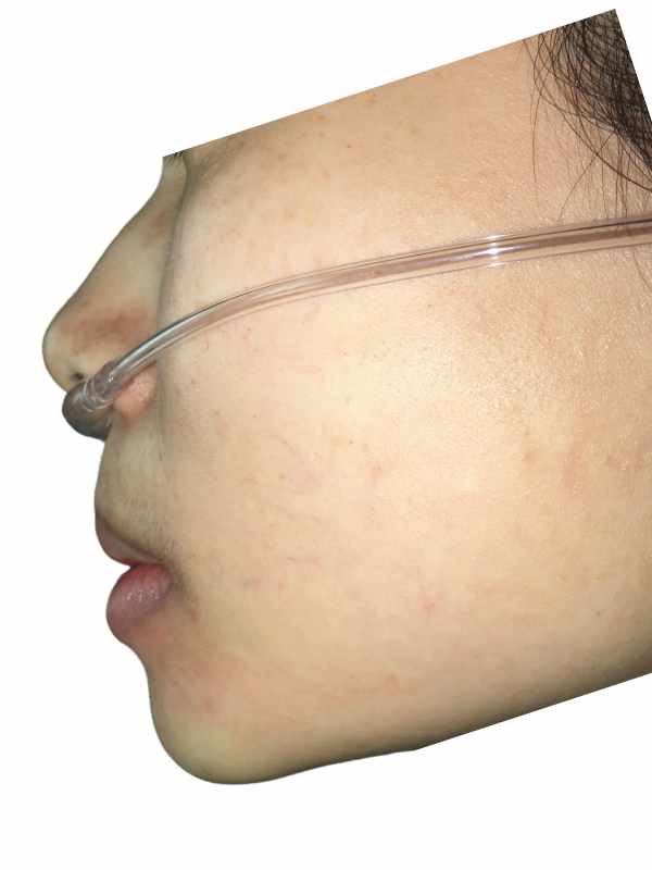 Chin Augmentation 2 After