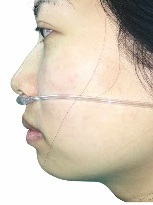 Chin Augmentation 2 Before