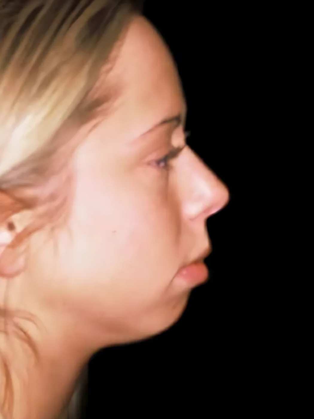 Chin Augmentation