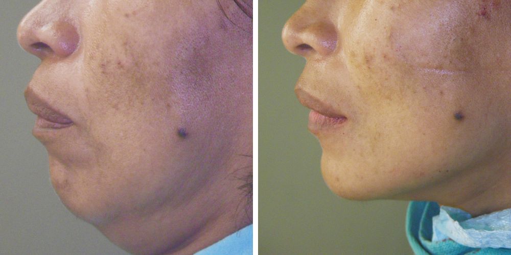 Chin Implant