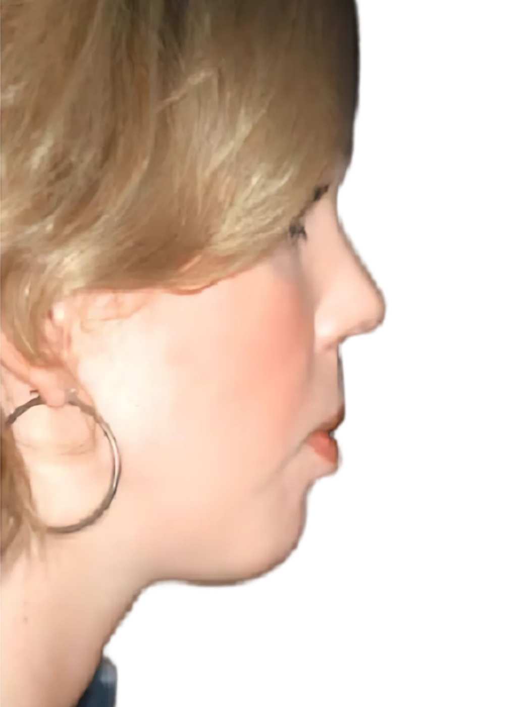 Chin Implant 2