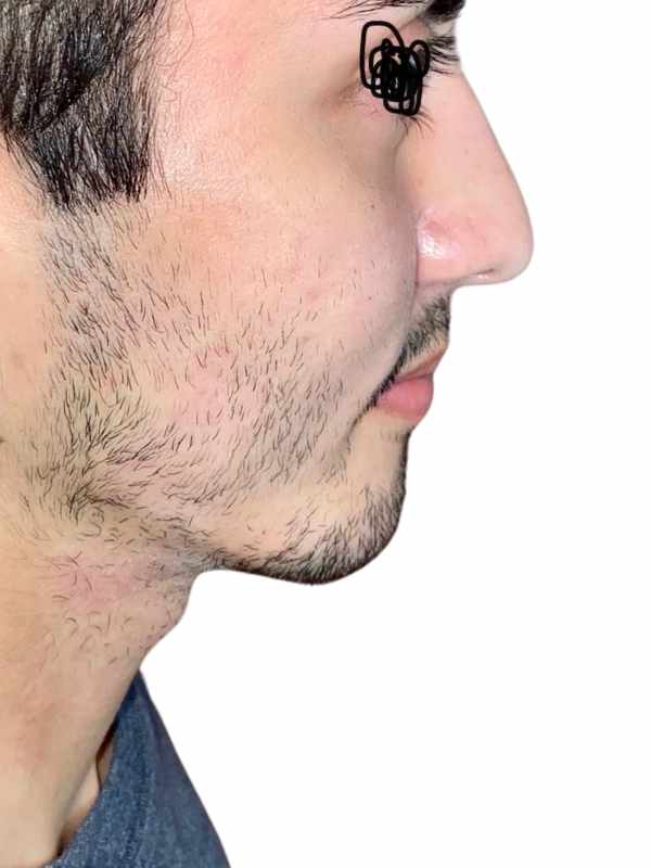 Chin Implant After