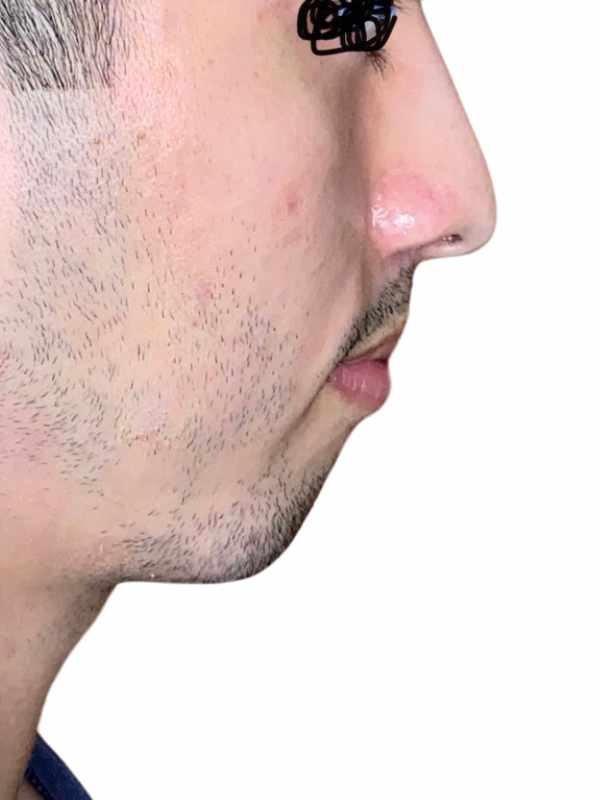 Chin Implant Before