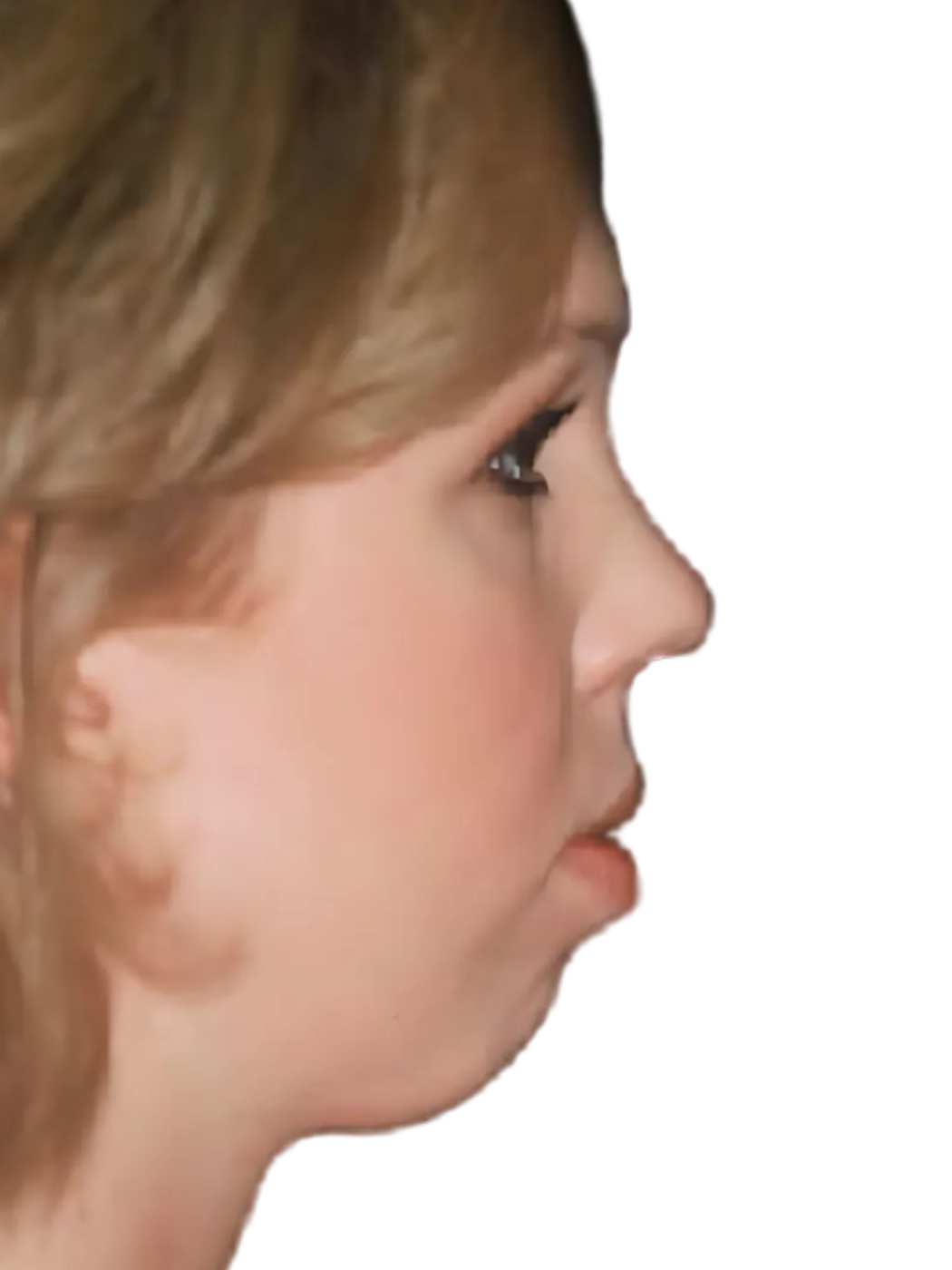 Chin Implant
