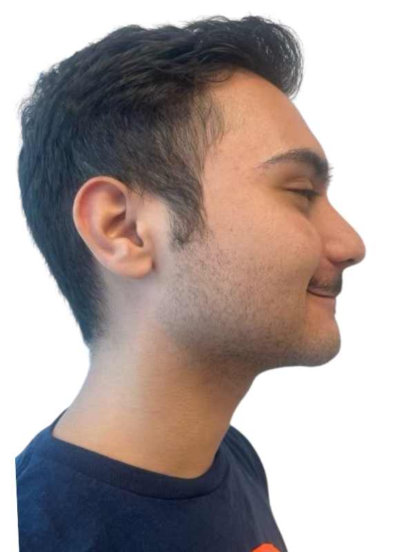 Chin Reduction 2