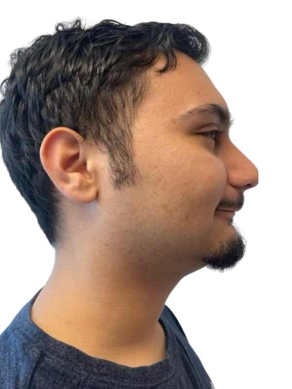 Chin Reduction