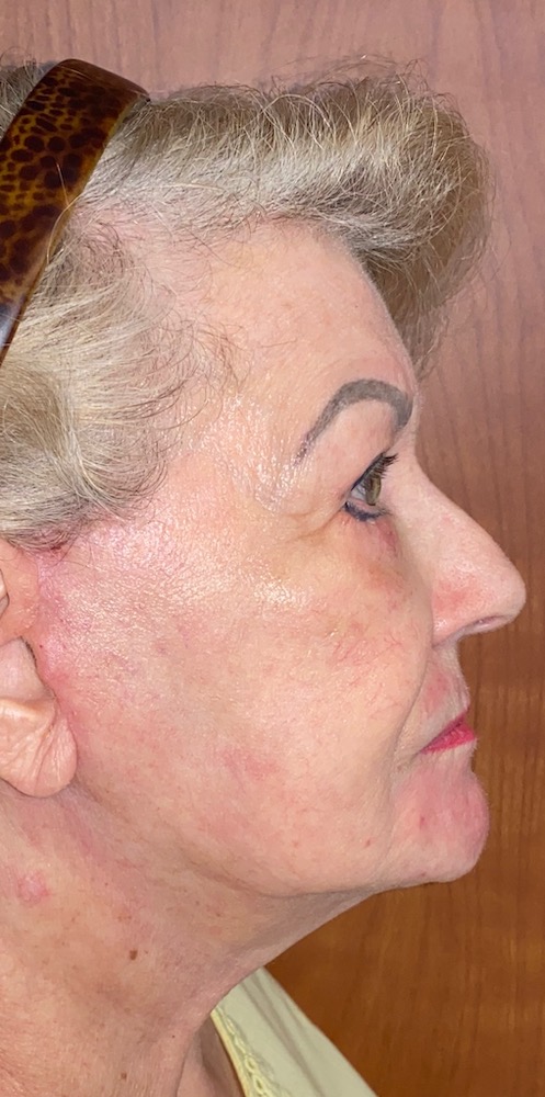 Facelift After
