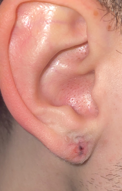 Scar Revision After