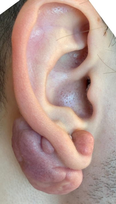 Scar Revision Before