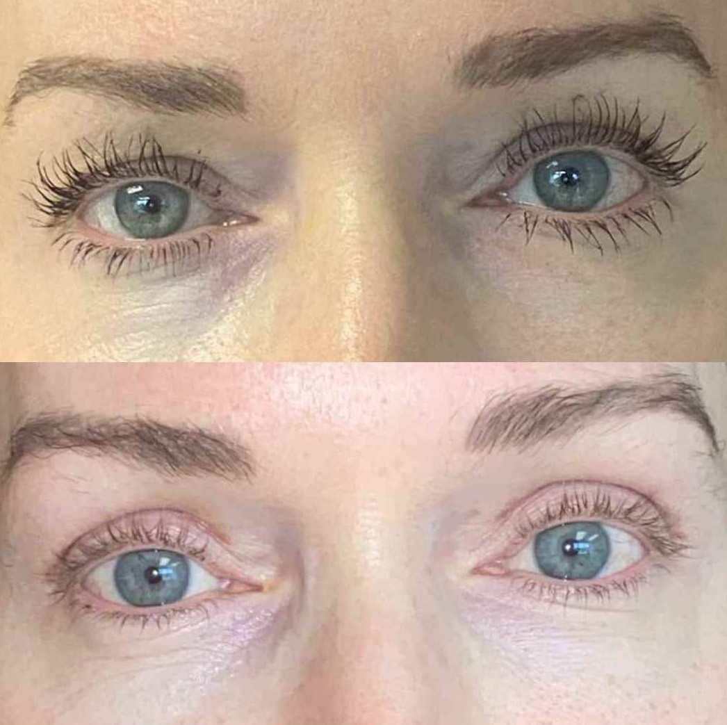 Dr Freeman Before After 500 x 1000 px - Upper Blepharoplasty